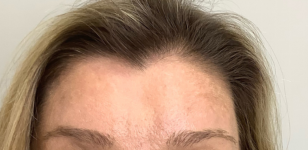 Botox