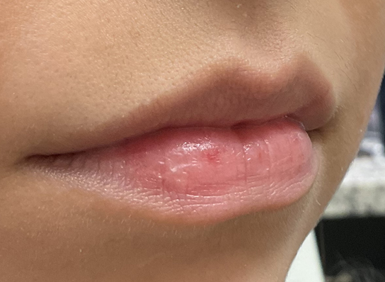 Patient before Lip Fillers procedure