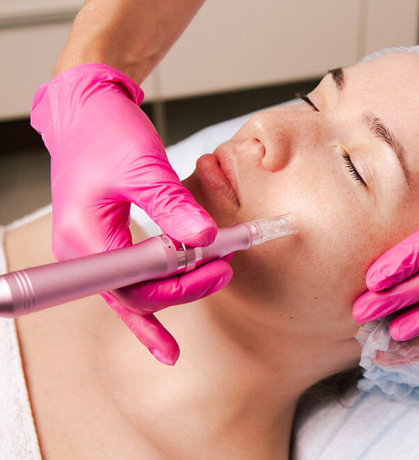 Microneedling procedure on cheek