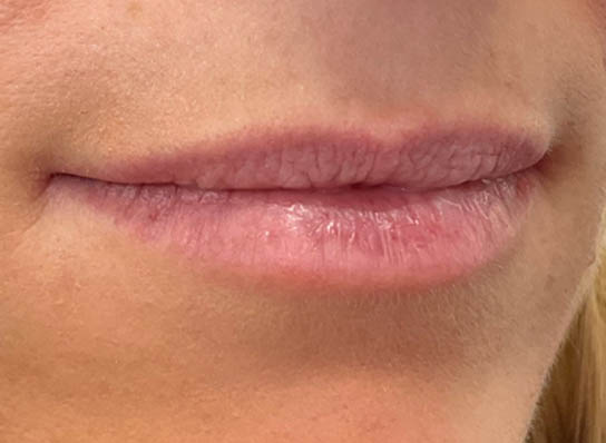 Lip Fillers
