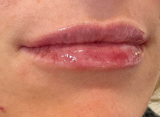 Lip Fillers