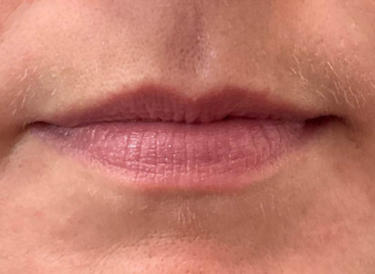 Lip Fillers
