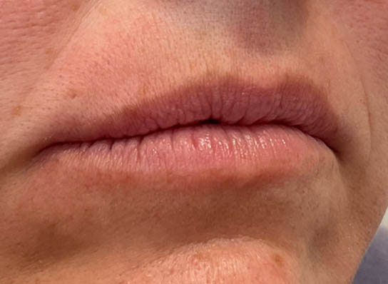 Lip Fillers