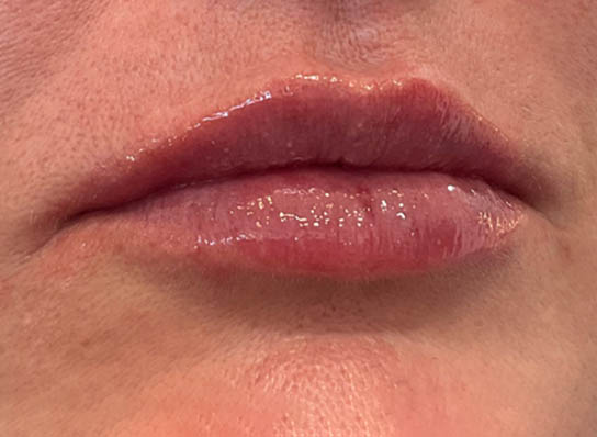 Lip Fillers
